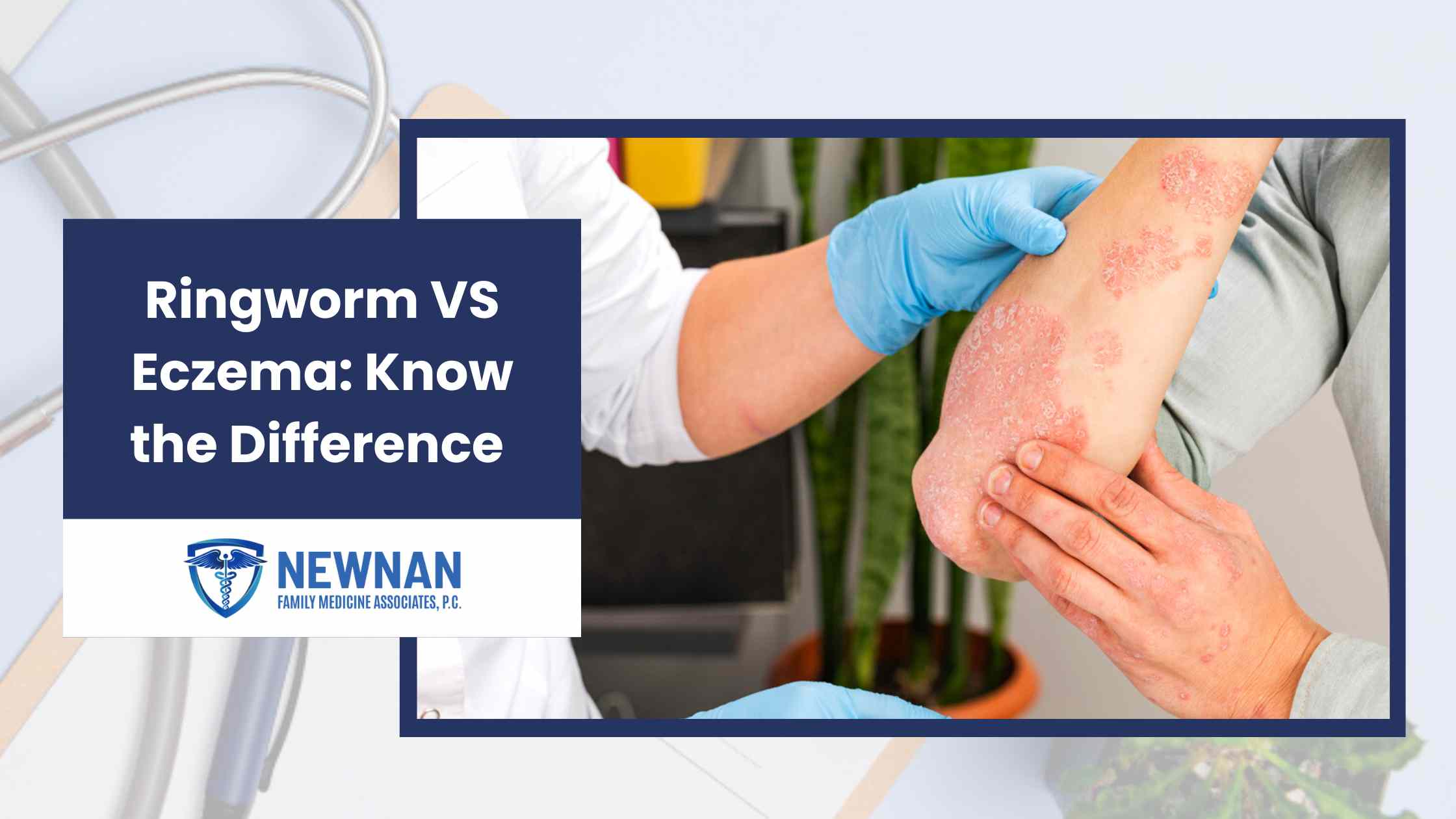 Ringworm VS Eczema: Know the Difference